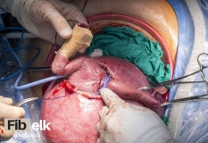 Fetal-surgery-11_800x550