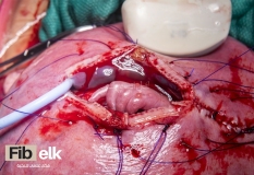 Fetal-surgery-12_800x550